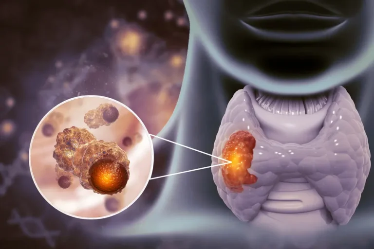 Cancer-de-tireoide